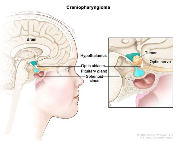 Craniopharyngioma diagrama